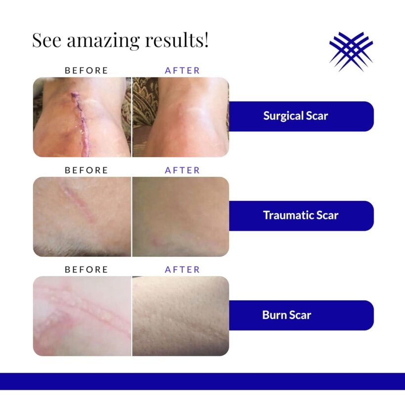 سيليكون جل ريجوفاسيل RejuvaSil Silicone Scar Gel 10ML