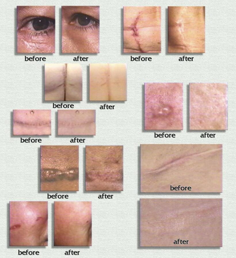 سيليكون جل ريجوفاسيل RejuvaSil Silicone Scar Gel 10ML