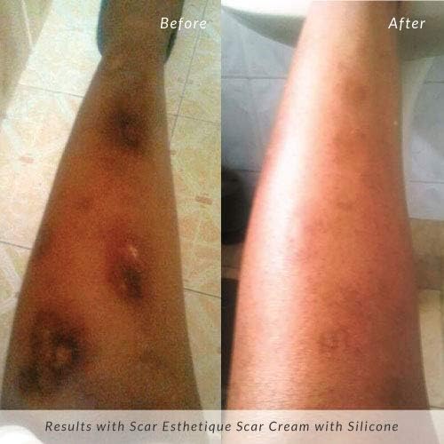 سيليكون جل ريجوفاسيل RejuvaSil Silicone Scar Gel 10ML