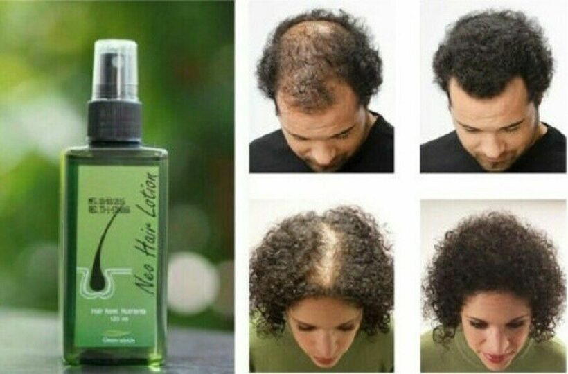 نيو هير لوشن علاج تساقط الشعر الأصلي NEO HAIR LOTION