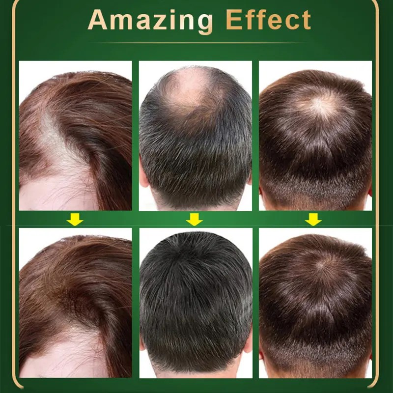 نيو هير لوشن علاج تساقط الشعر الأصلي NEO HAIR LOTION