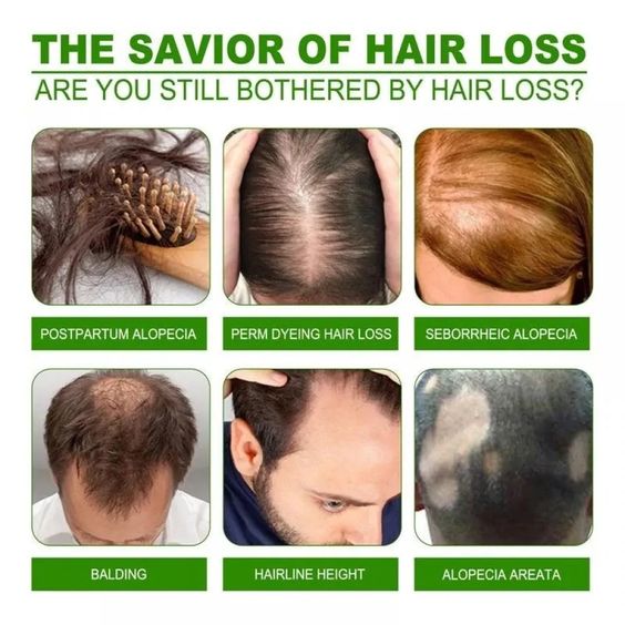 نيو هير لوشن علاج تساقط الشعر الأصلي NEO HAIR LOTION