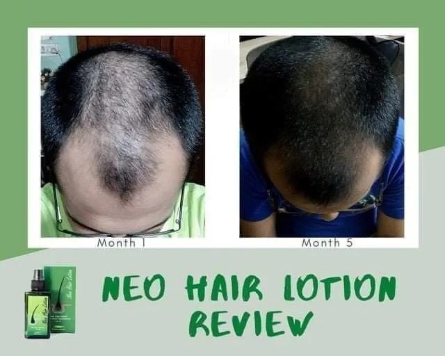 نيو هير لوشن علاج تساقط الشعر الأصلي NEO HAIR LOTION
