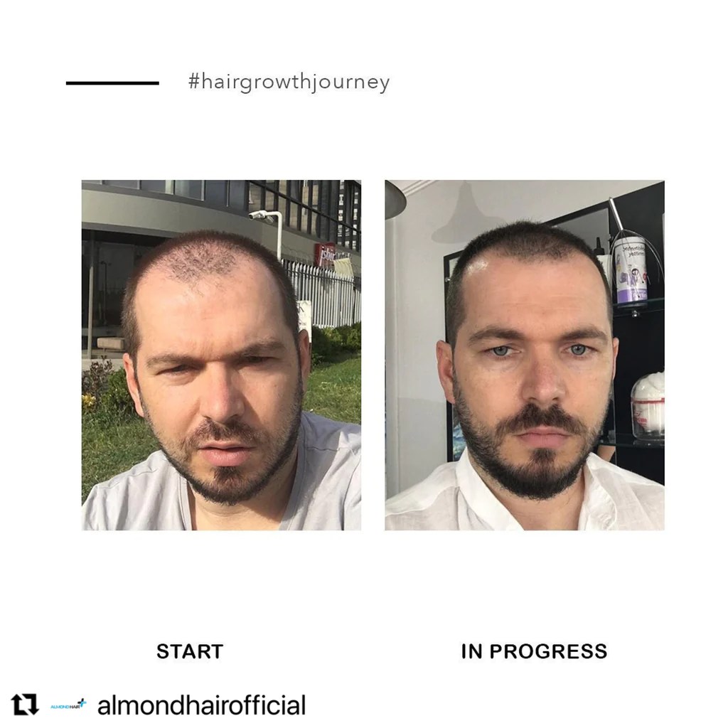 الموند هير ALMOND HAIR سيروم تطويل و تكثيف الشعر للرجال