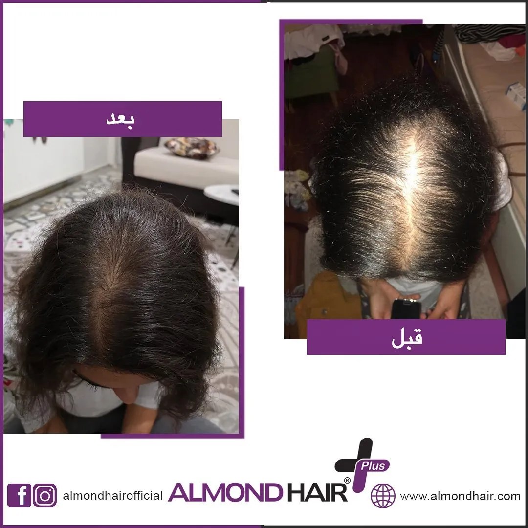 الموند هير مجموعة تطويل و تكثيف الشعر للنساء ALMOND HAIR