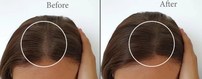 فوركابيل لوشن تقوية و علاج تساقط الشعر FORCAPIL HAIR LOTION