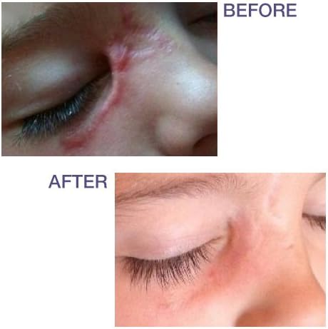 PROCIL GEL بروسيل جل لعلاج اثار الجروح و الندبات