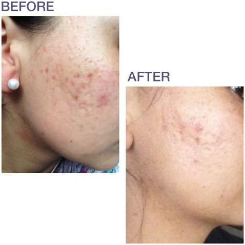 PROCIL GEL بروسيل جل لعلاج اثار الجروح و الندبات